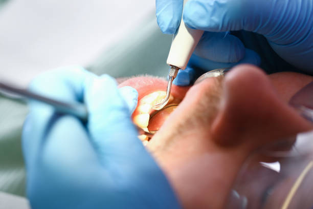 Best Emergency Tooth Extraction in Idyllwild Pine Cove, CA
